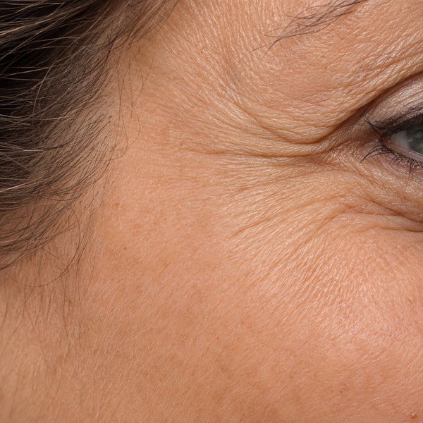 Fine lines & Wrinkles