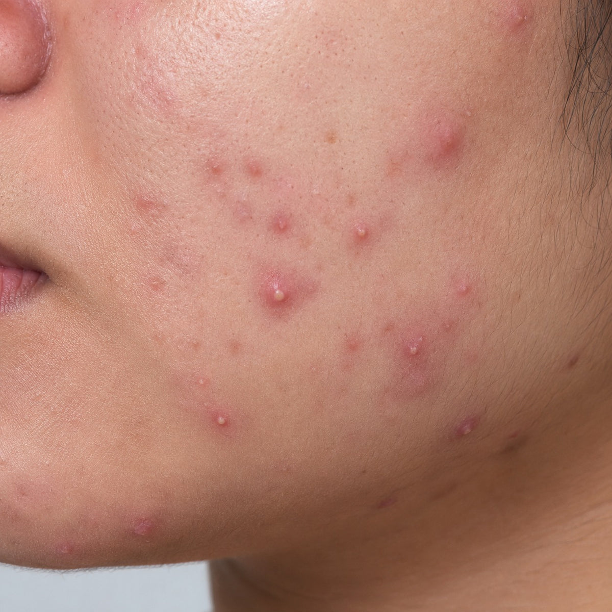 Acne - Prone skin
