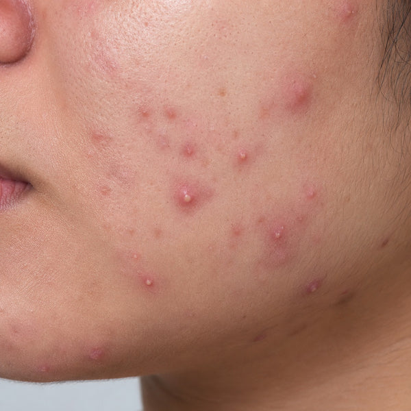 Acne - Prone skin