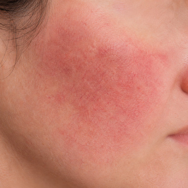 Sensitive & Rosacea