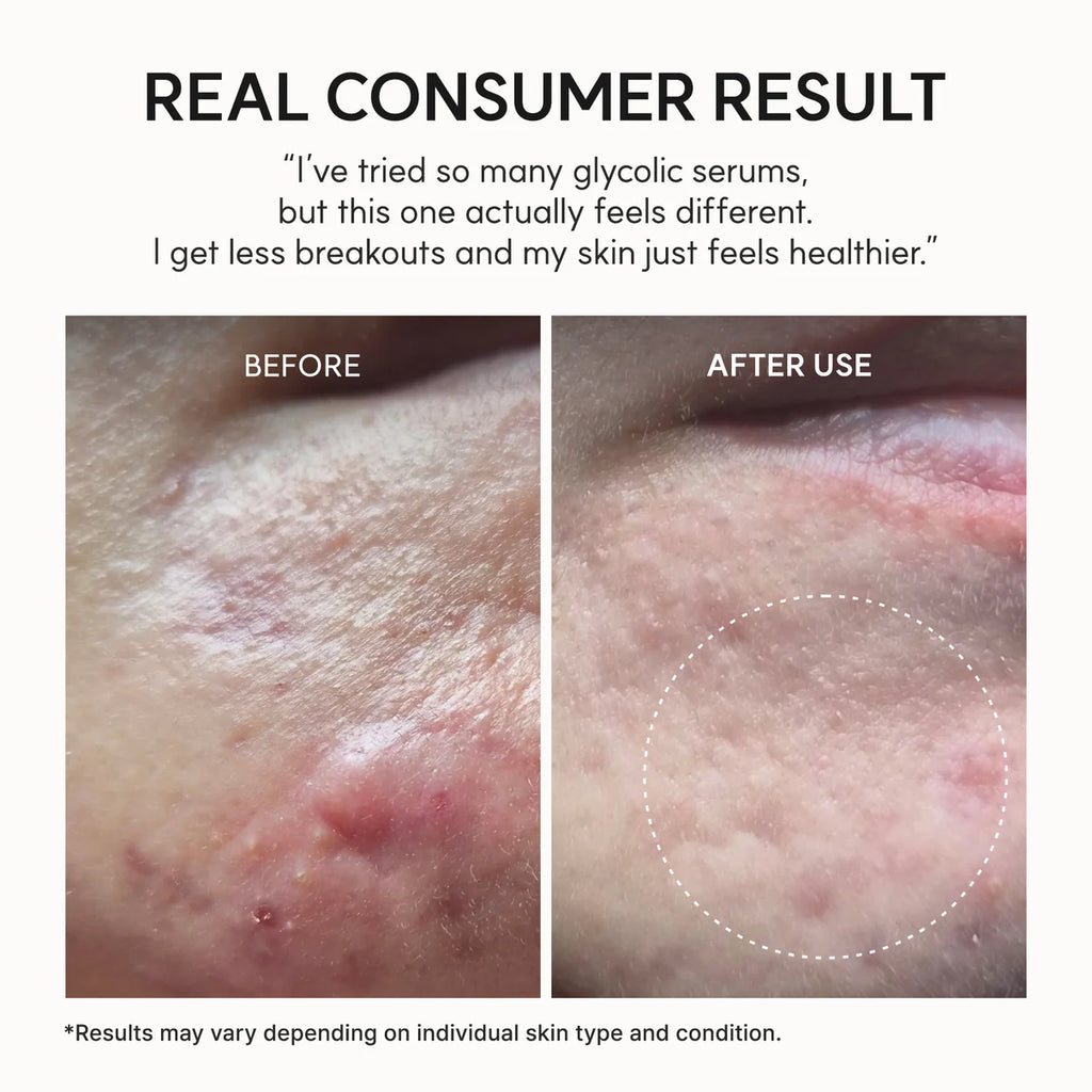 Arencia - Eraser Shot Glycolic Acid Booster Shot