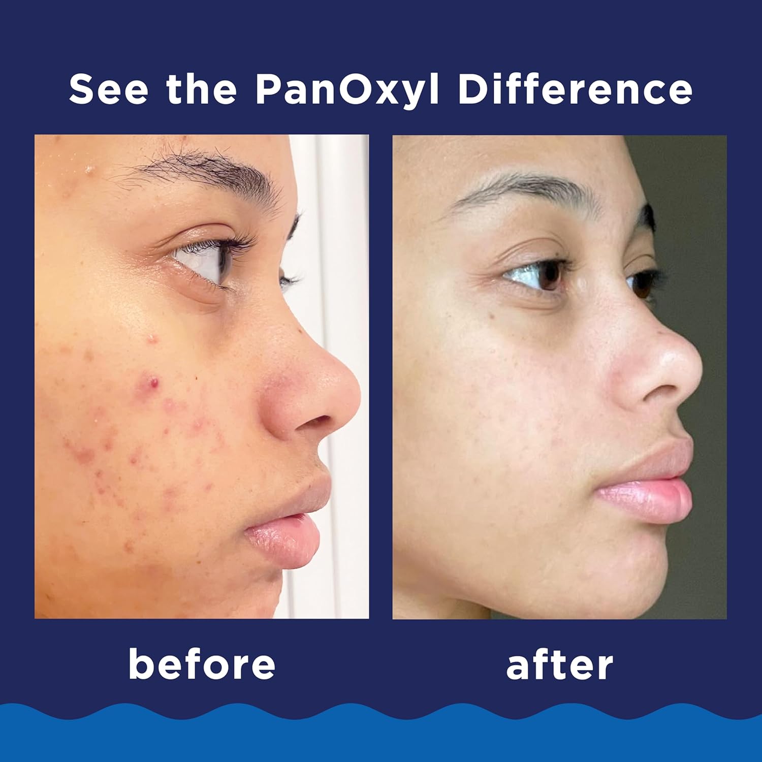 PanOxyl - Acne Foaming Wash Benzoyl Peroxide 10% Maximum Strength