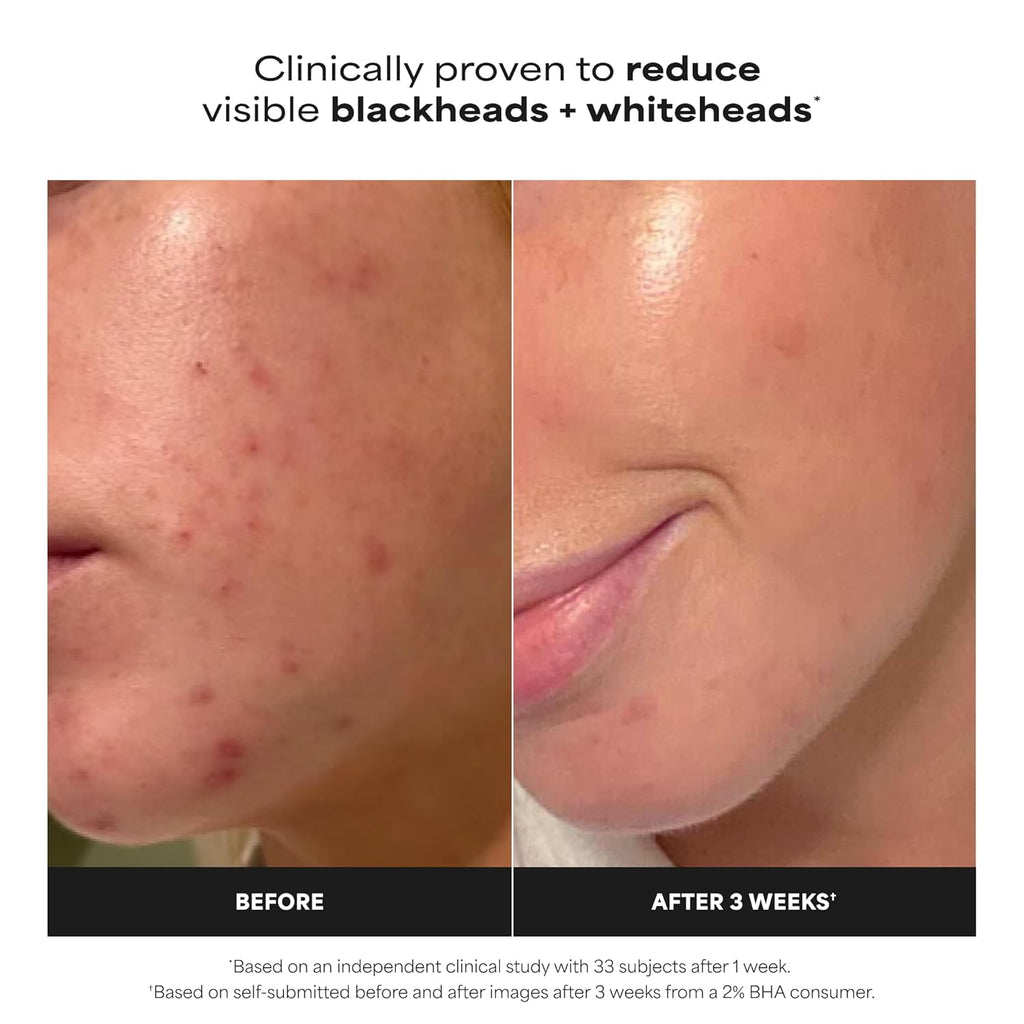 PAULA'S CHOICE - Skin Perfecting 2% BHA Liquid Exfoliant