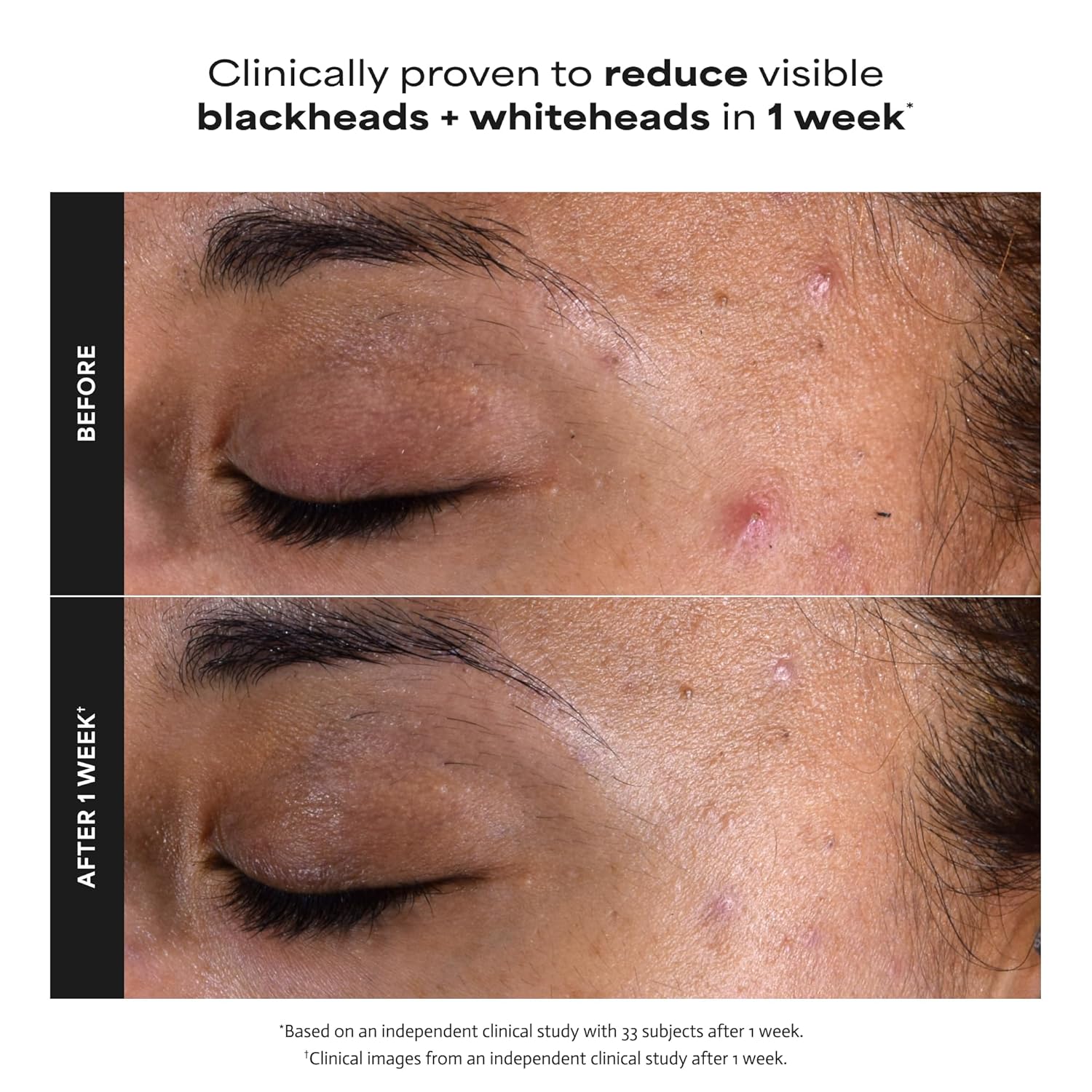 PAULA'S CHOICE - Skin Perfecting 2% BHA Liquid Exfoliant