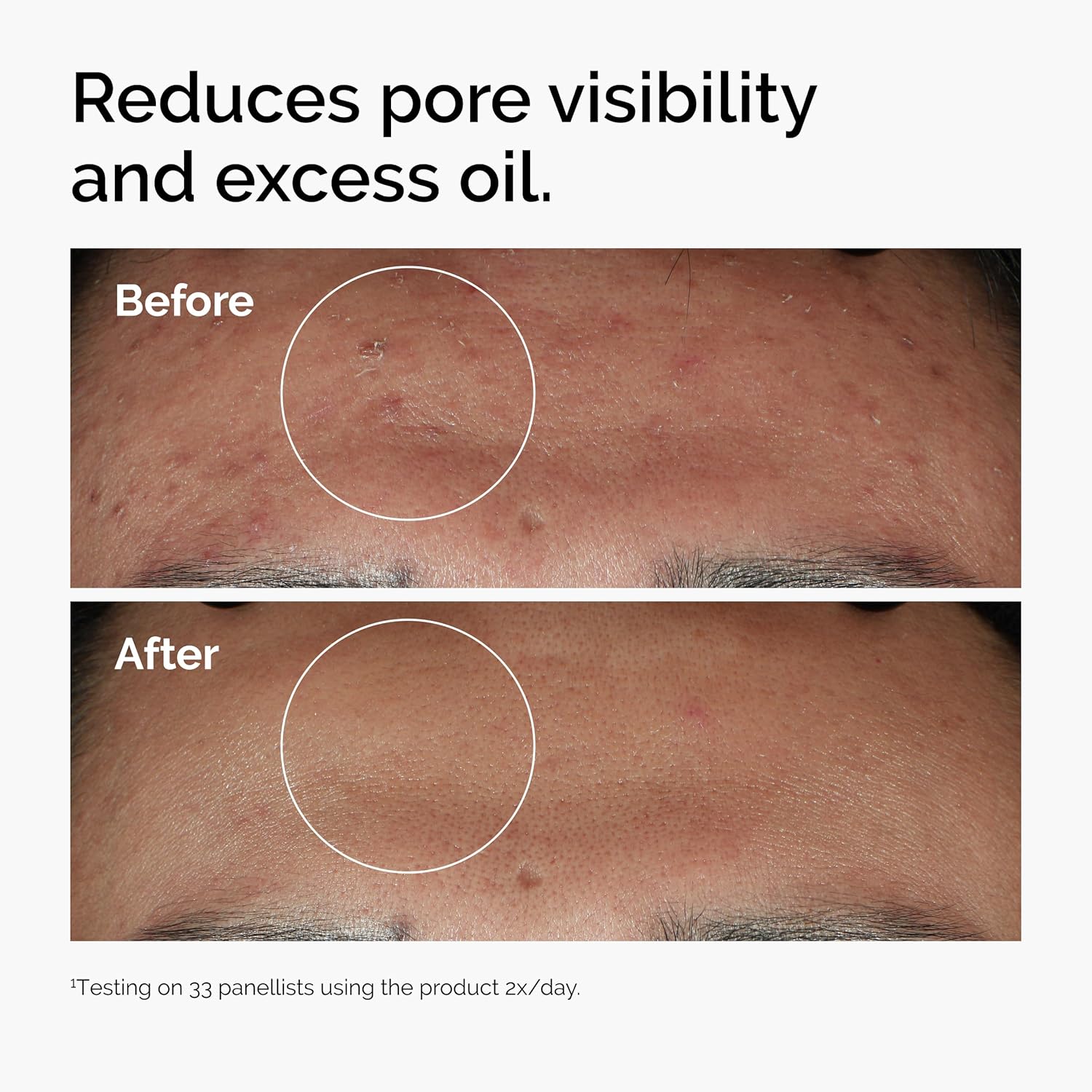 The Ordinary - 1%Niacinamide 10% + Zinc 1%