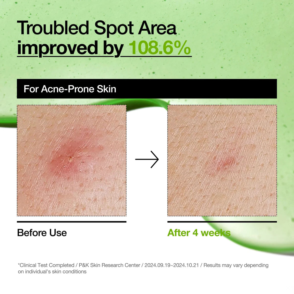 Anua - Azelaic Acid 10 Hyaluron Redness Smoothing Serum 30ml